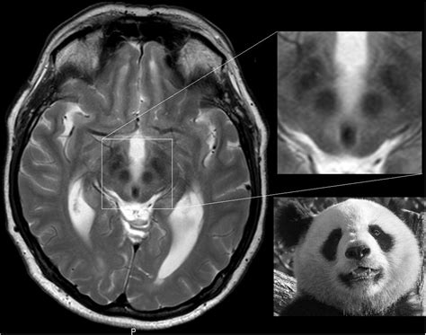 “face Of The Giant Panda” And Hydrocephalus Journal Of Clinical