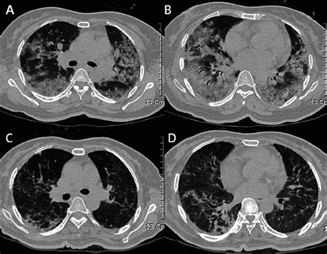 Chest Ct Obtained At Admission Showing Bilateral And Patchy Ground
