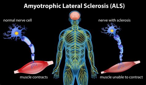 anatomía de la esclerosis lateral amiotrófica 296311 vector en vecteezy