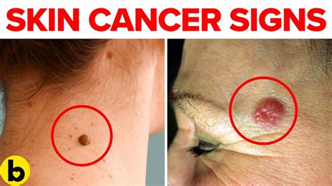 Warning Signs You May Have Skin Cancer Youtube