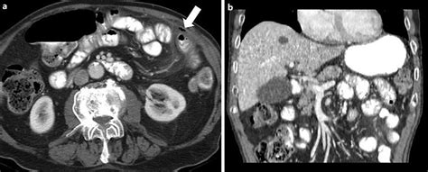 A Axial Ct Scan Of The Abdomen With Intravenous And Download