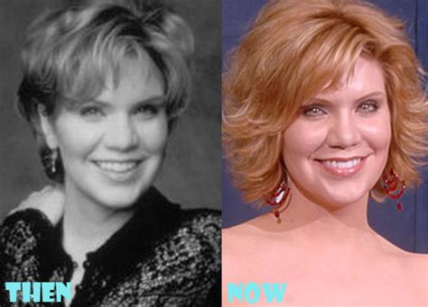 Alison Krauss Plastic Surgery Before and After Photo ...