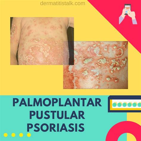 Palmoplantar Pustular Psoriasis Is Less Common But Very Serious Type