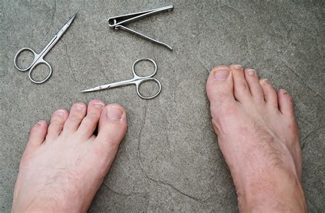 How To Treat Ingrown Toenails A Complete Guide Advance Foot Clinic