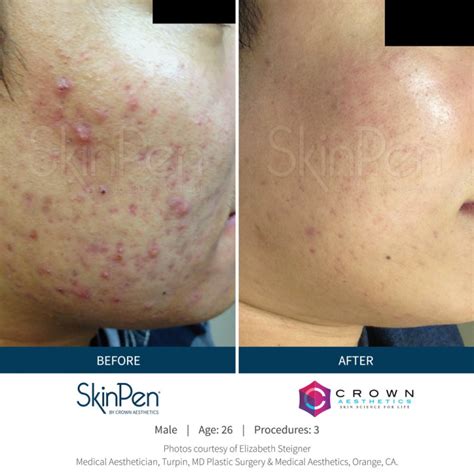 Skinpen® Microneedling Skin Treatment Quinn Clinics