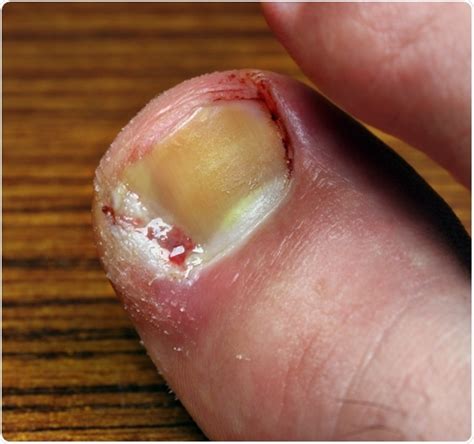 Collection 97 Wallpaper Types Of Nail Diseases With Pictures Updated