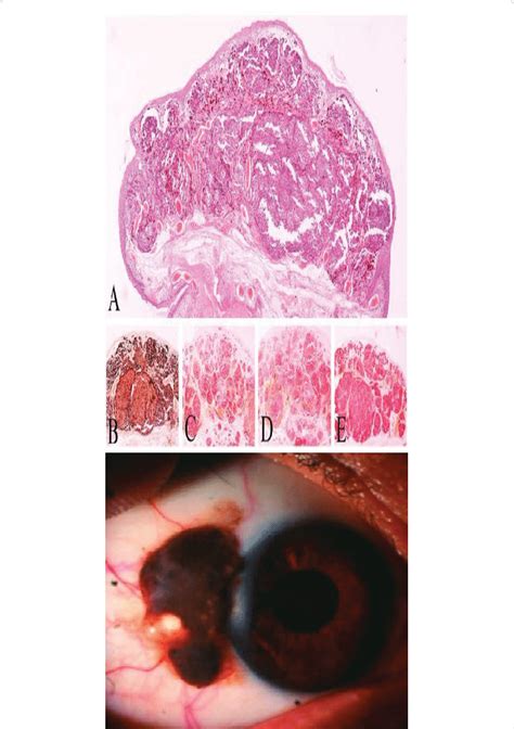 Right Eye Conjunctival Melanoma At The Interpalpebral Bulbar