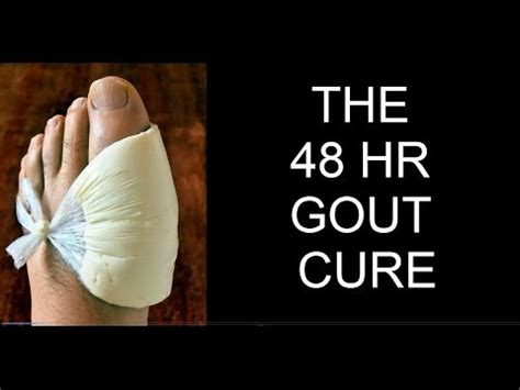 How do i cure my gout foot fast?? GOUT,PODAGRA,TOPHI,PSEUDOGOUT | 48 HR CURE DISCOVERED FOR ...