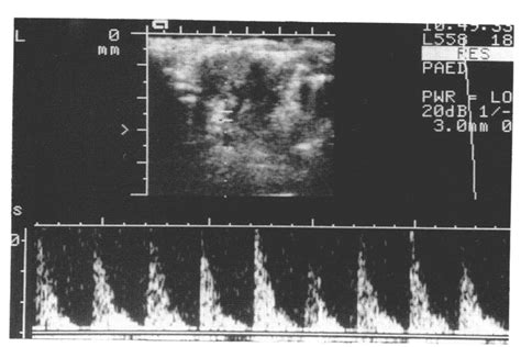 Renal Arterial Doppler Signal With Duplex Image Showing The Hilum Of