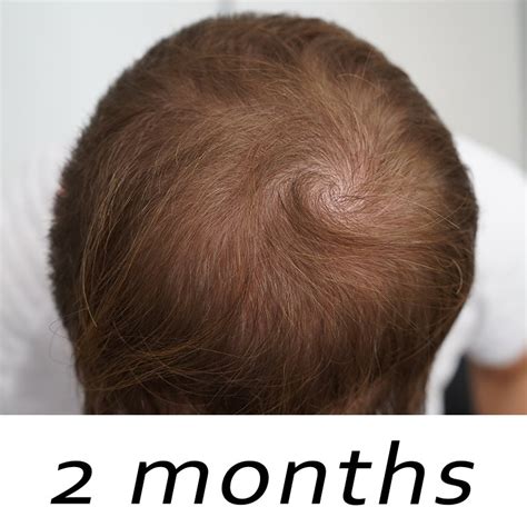 Topical Finasteride Before And After Results Matt Dominance