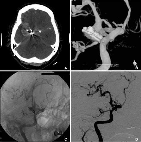 Before Coiling Aneurysm Clip And Thick Subarachnoid Hemorrhage Are