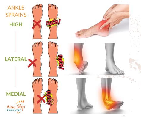 Foot And Ankle Sprain