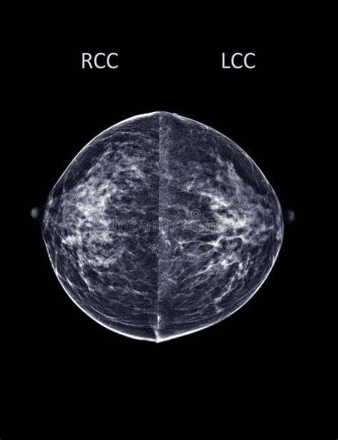 X Ray Digital Mammogram Or Mammography Both Side Of The Breast Cc View