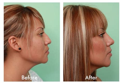 Rhinoplasty Before And After Pictures Vida Wellness And Beauty Tijuana