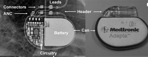 Emergency Medicine Educationecg Pointers Pacemakers