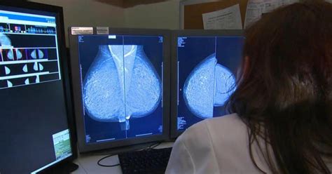 Research Suggests Chemotherapy Alternative For Early Stage Breast Cancer Cbs News