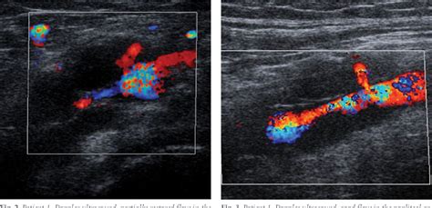 Figure 3 From Ultrasound Guided Percutaneous Aspiration Of Adventitial
