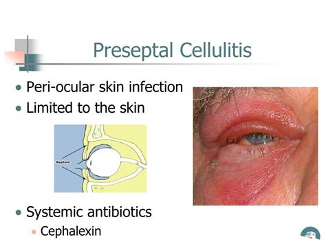 Orbital Cellulitis Adult Treatment