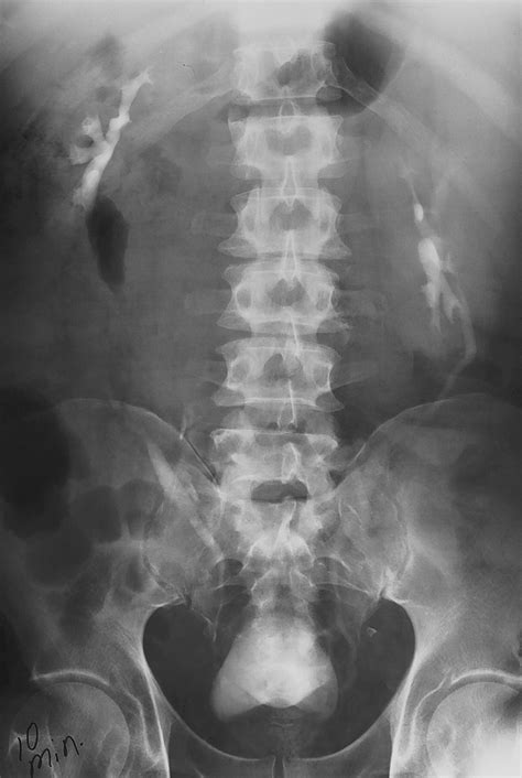 Intravenous Urography Technique And Interpretation Radiographics