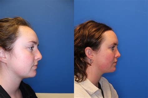 Nose Surgery Before And After Photos Patient 284 San Francisco Ca