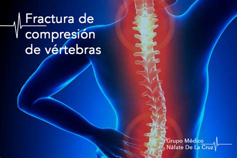 ¿qué Es La Fractura De Compresión De Vértebras Cm Náfate De La Cruz
