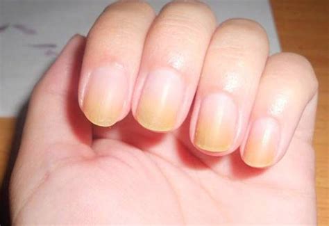 What Are The Symptoms Of Yellowing Of Fingernails And Toenails