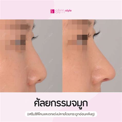Nose Surgery Augmentation And Refinement Of The Nasal Tip Stm Style
