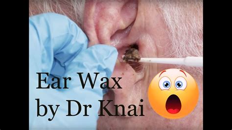 Ear Wax Removal Compilation 2020 Youtube
