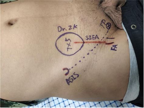 Thin Superficial Inferior Epigastric Artery Perforator Flap For
