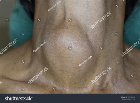 Zooming Closeup View Enlarged Thyroid Gland Stock Photo Edit Now
