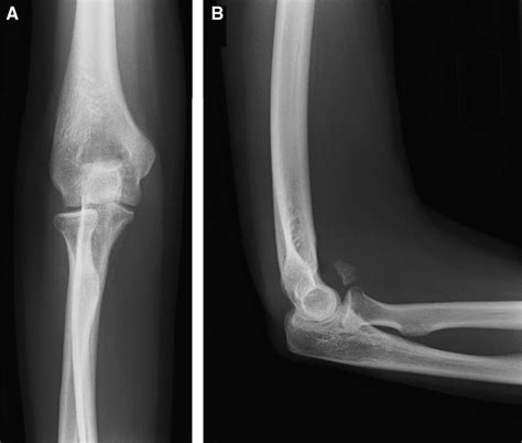 Isolated Anterolateral Fracture Of The Coronoid Process Of The Ulna A