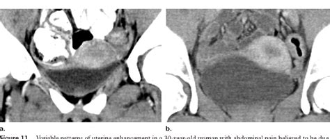figure 11 from normal or abnormal demystifying uterine and cervical contrast enhancement at