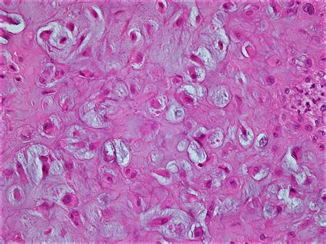Pathology Outlines Chondromyxoid Fibroma