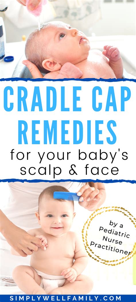 Cradle Cap What Is It And How To Treat It Cradle Cap Remedies