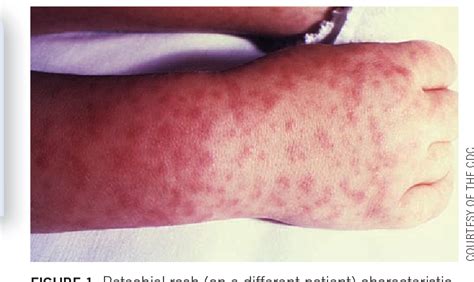 Figure 1 From An Unusual Case Of Sepsis And Petechial Rash Semantic