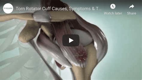 The Basics Of Rotator Cuff Tears Able Orthopedic And Sports Medicine