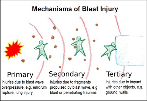 Schematic Representation Of Blast Injury Mechanisms Download Scientific Diagram