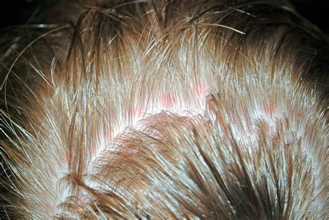 Red Spots On Scalp Pictures Photos