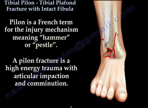 Tibial Pilon Fracture With Intact Fibula —
