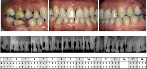 Nonsurgical Periodontal Therapy To Treat A Case Of Severe Periodontitis