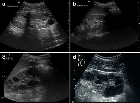 Typical Sonographic Images Of Autosomal Dominant Polycystic Kidney
