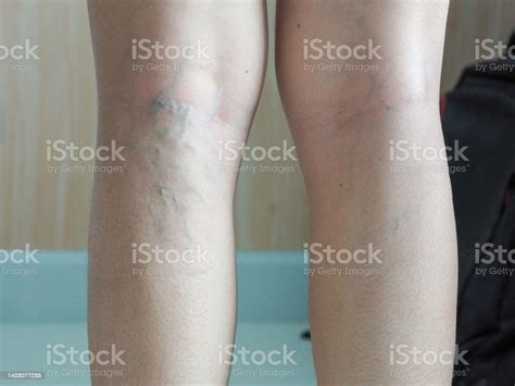 Varicose Veins On A Womans Leg Vascular Disease Varicose Veins Problem