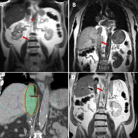 Mri Images Of A 74 Yo Man With Right Renal Mass Arrow And Tumor