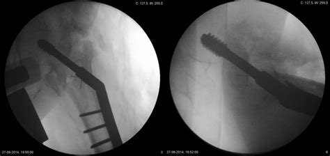 The Patient Underwent Extraction Of The Gamma3 Nail And Revision