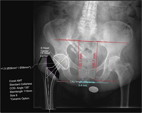 I Informed Consent And Pre Operative Planning For Total Hip