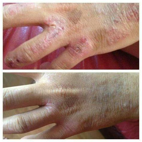 Psoriasis Before And After Seacret Seacret Skincare Skin Care