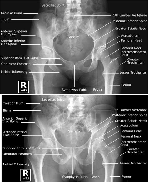 Labeled Radiographic Anatomy Of The Male Bottom Image And Female Top