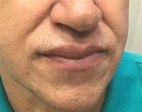 Swelling Of Lips Tongue And Throat Icd 10