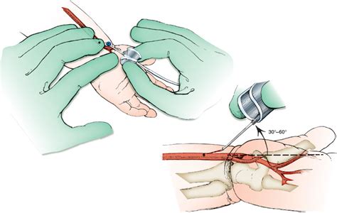 Procedures Anesthesia Key
