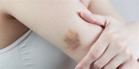 What You Should Know About Hematomas Great Lakes Hemophilia Foundation
